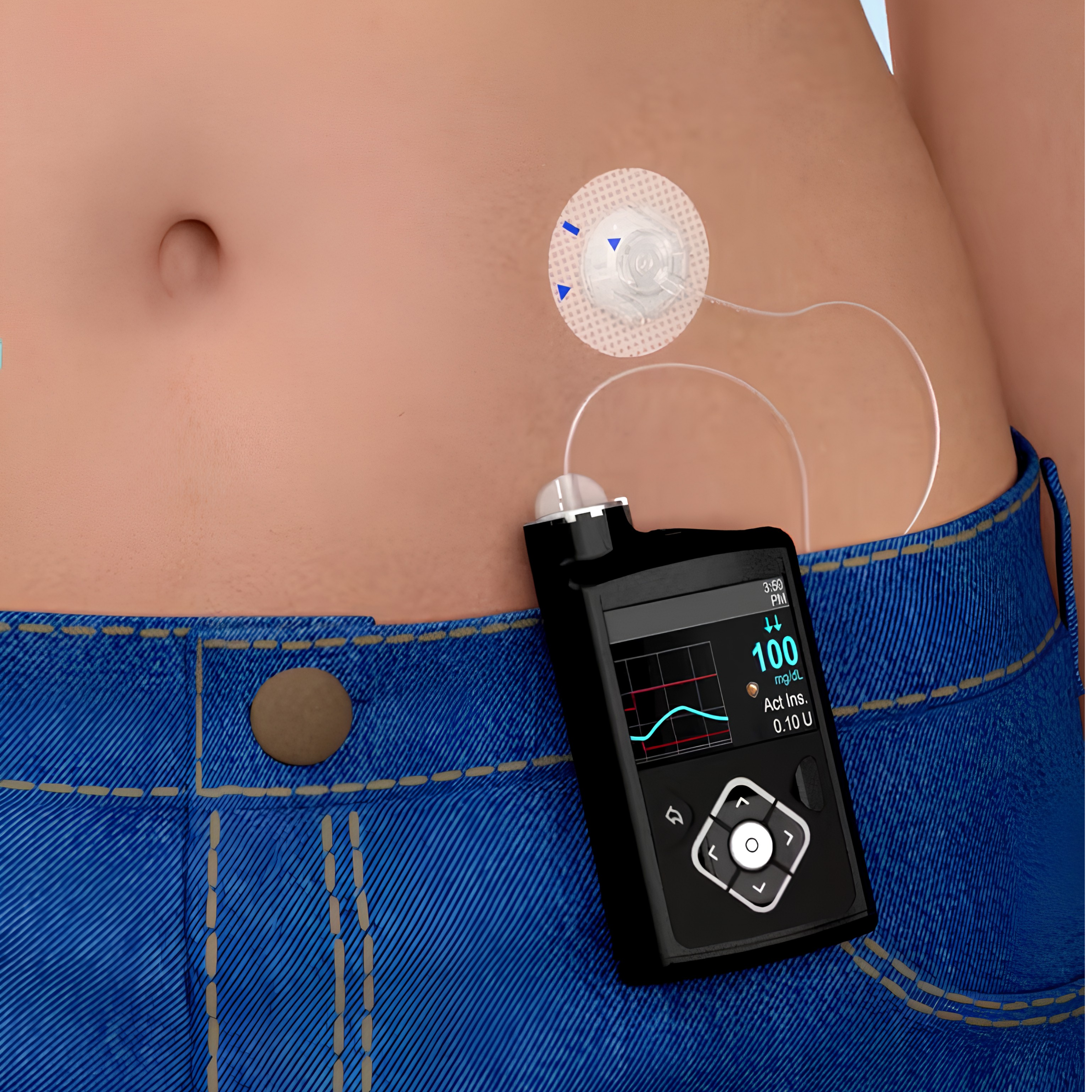 MiniMed 720G Insulin Pump